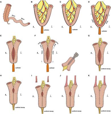 Robot-Assisted Laparoscopic Radical Cystectomy and Modified Y-Shaped Ileal Orthotopic Neobladder Reconstruction